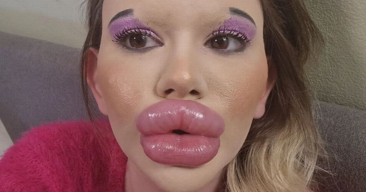 copy of articles thumbnail 1200 x 630 2025 07 28t033111 463.jpg - Woman With 'World's Biggest Lips' Reveals Her Face Before Surgery